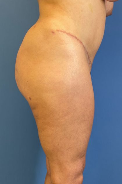 Brazilian Butt Lift (BBL) Before & After Patient #5352