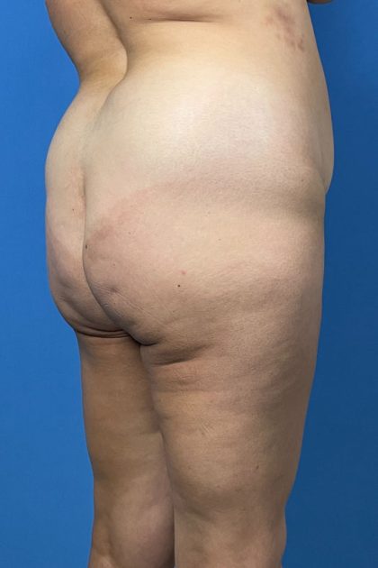 Brazilian Butt Lift Before & After Patient #5352