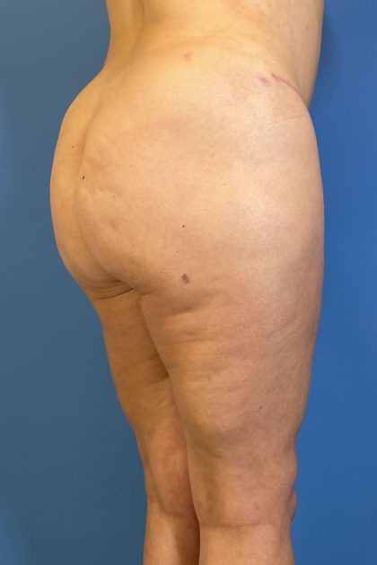 Lipoabdominoplasty Before & After Patient #5547