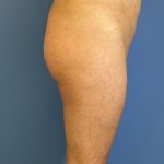 Brazilian Butt Lift Before & After Patient #5376