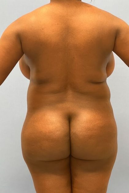 Vaser Liposuction Before & After Patient #5705