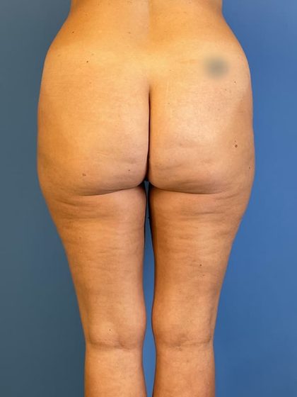 Liposuction Before & After Patient #5709