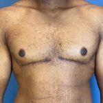 Gynecomastia Before & After Patient #6647