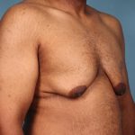 Gynecomastia Before & After Patient #6647