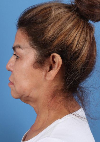 Facelift Before & After Patient #7646