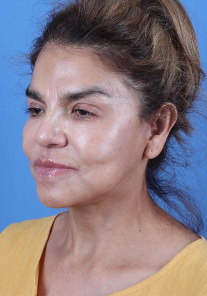 Facelift Before & After Patient #7646