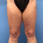Thighplasty Before & After Patient #7766