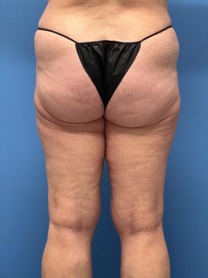 Thighplasty Before & After Patient #7766