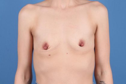 Breast Augmentation Before & After Patient #7768