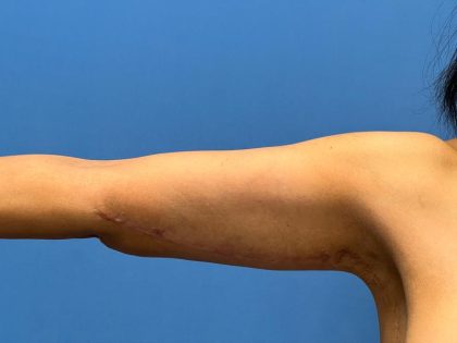 Arm Lift Before & After Patient #7769