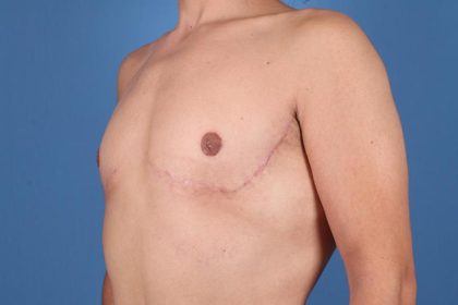 Gynecomastia Before & After Patient #7774