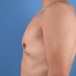 Gynecomastia Before & After Patient #7774
