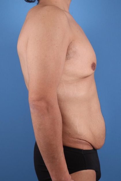 Tummy Tuck Before & After Patient #7773