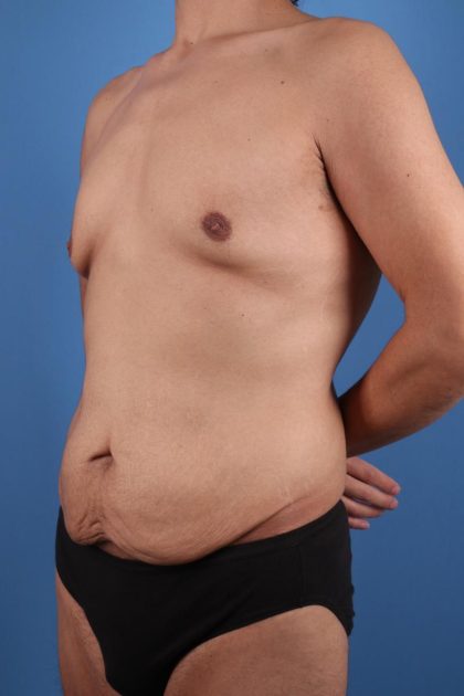 Tummy Tuck Before & After Patient #7773