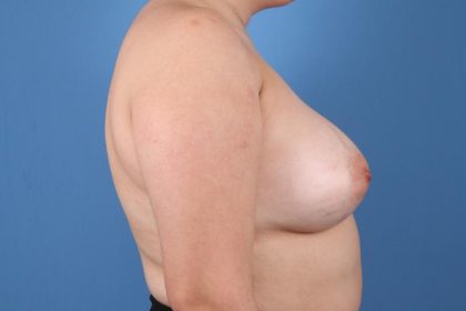 Breast Augmentation Before & After Patient #7776