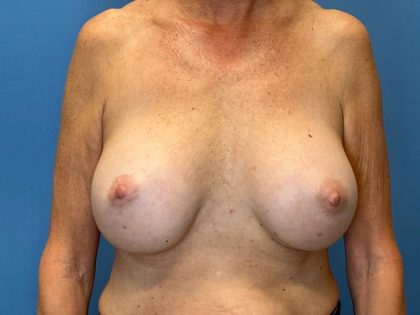 Breast Implant Replacement Before & After Patient #7777