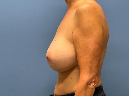 Breast Implant Replacement Before & After Patient #7777