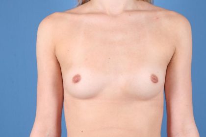 Breast Augmentation Before & After Patient #7823