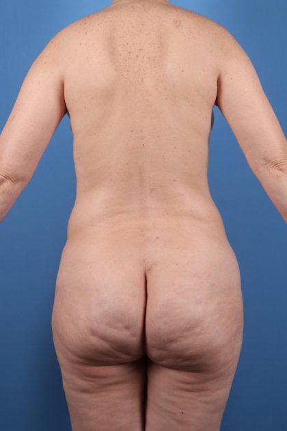 Vaser Liposuction Before & After Patient #7826