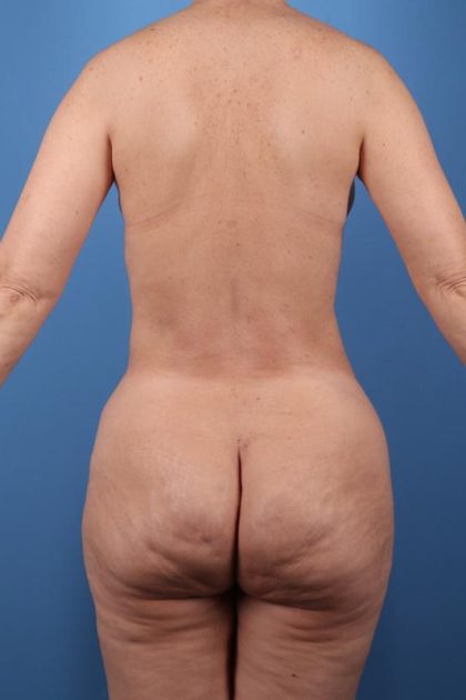 Vaser Liposuction Before & After Patient #7826