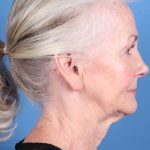 Facelift Before & After Patient #8445