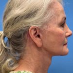Facelift Before & After Patient #8515